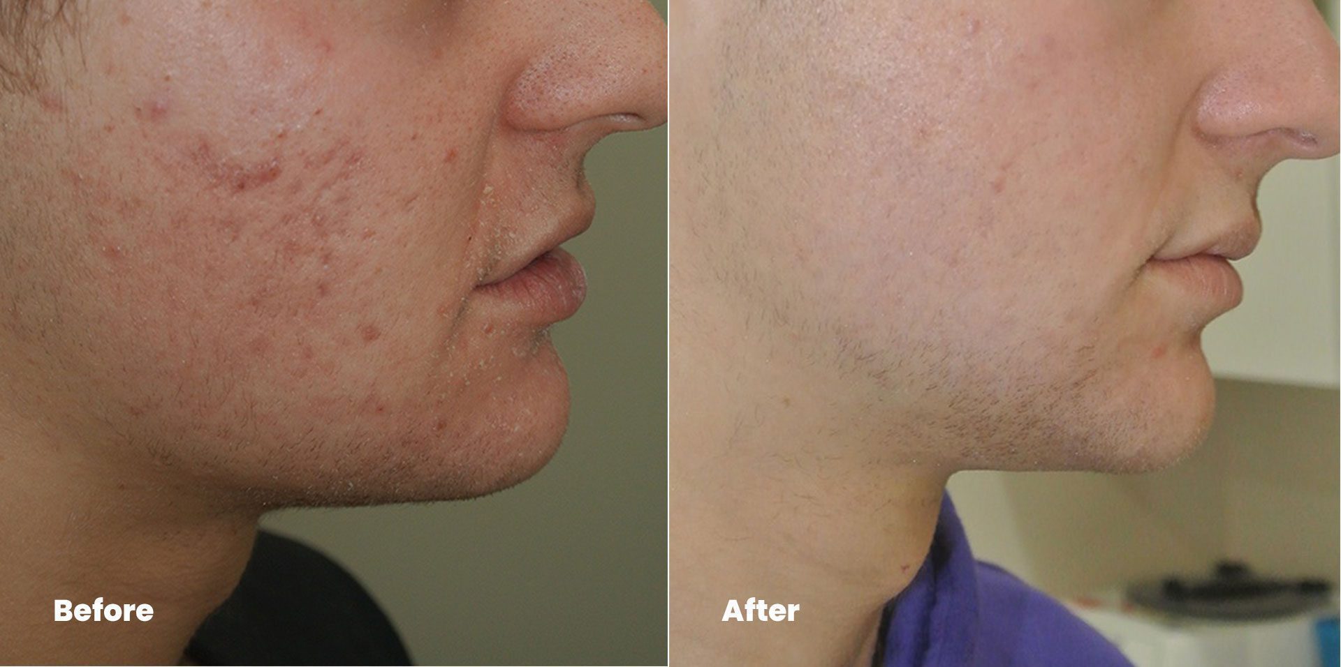 Rejuvie Aesthetic & Dermatology Bali before after PicoSure Laser treatment