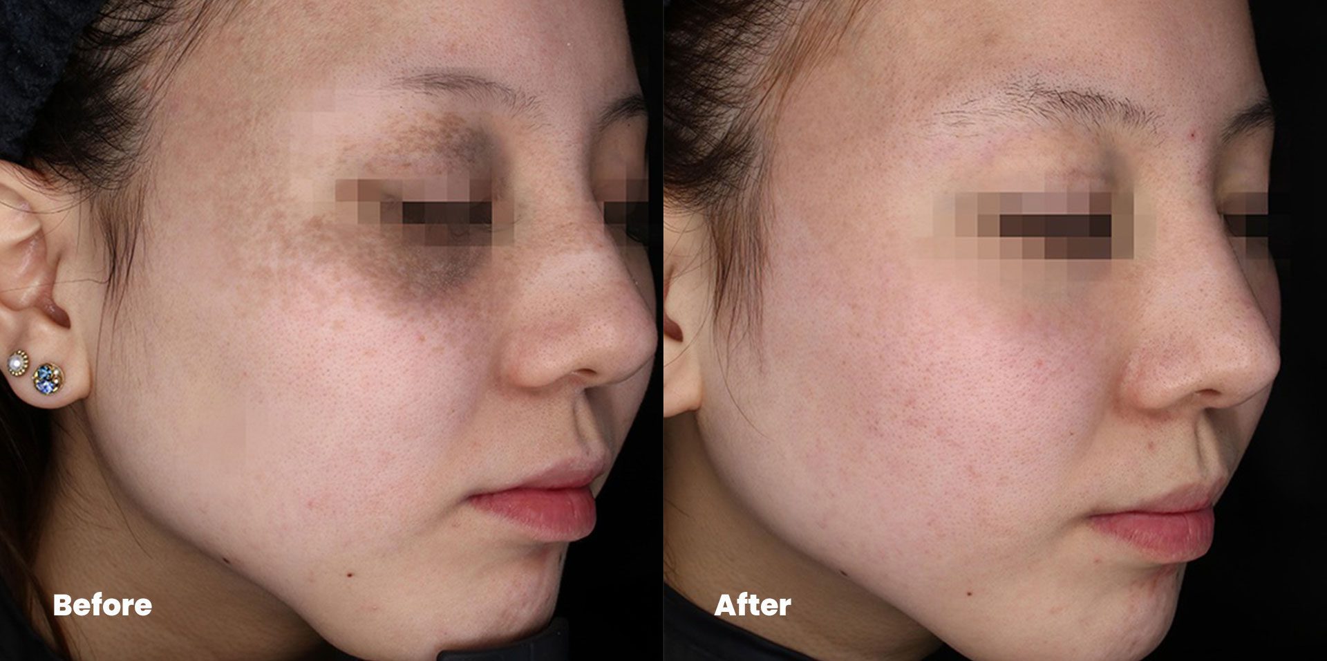 Rejuvie Aesthetic & Dermatology Bali before after PicoSure Laser treatment