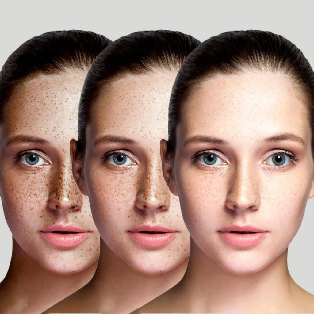 anti aging treatment at Rejuvie Aesthetic & Dermatology Bali