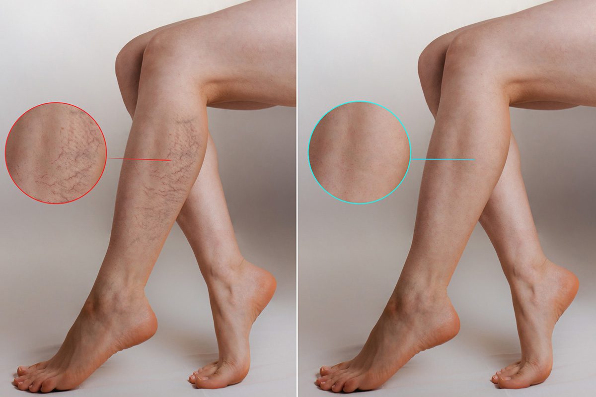 Spider Vein Removal treatment at Rejuvie Aesthetic and Dermatology bali